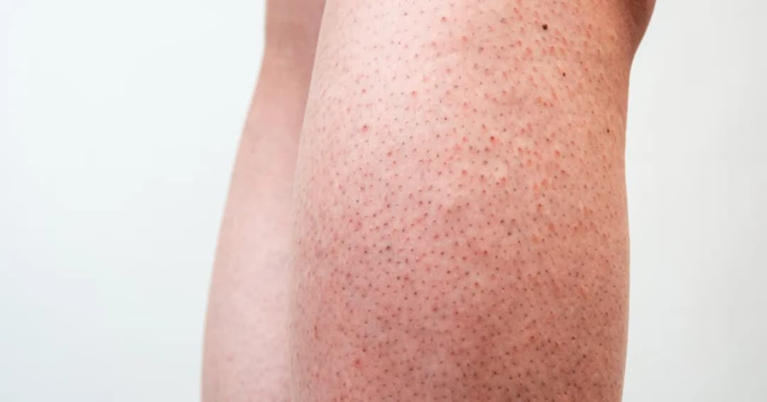 Jak skutecznie pozbyć się truskawkowych nóg i cieszyć się gładką skórą