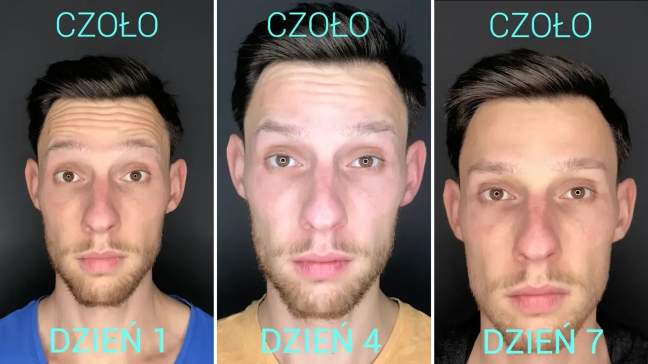 Na ile starcza botoks? Poznaj fakty o trwałości efektów