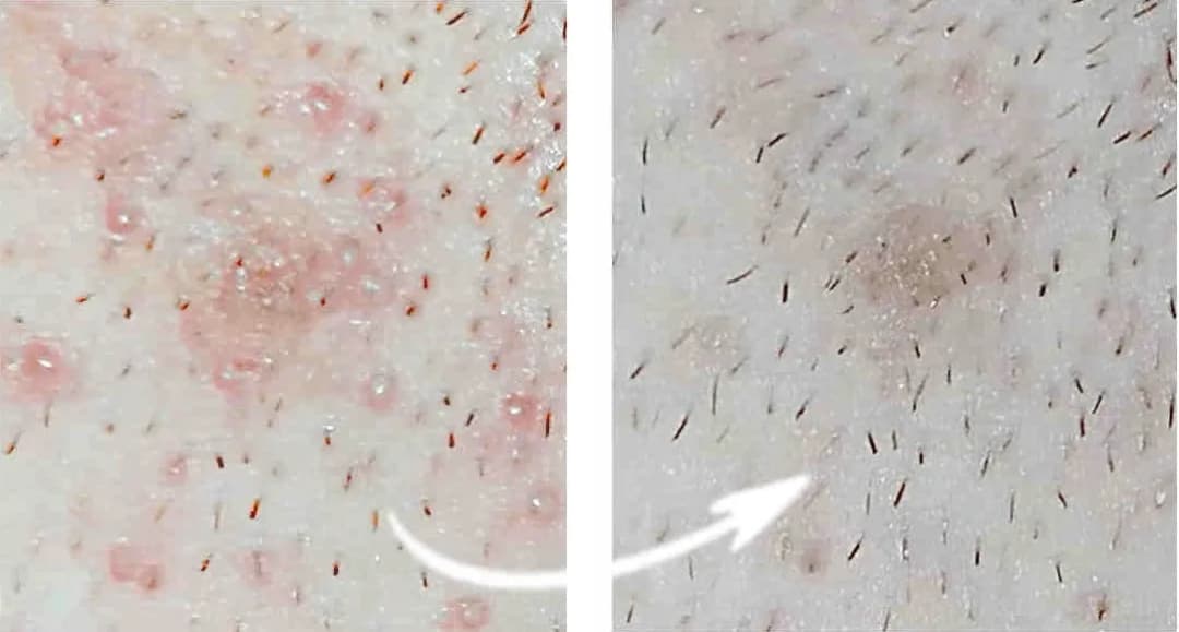 Krostki po goleniu czym smarować, aby szybko złagodzić podrażnienia