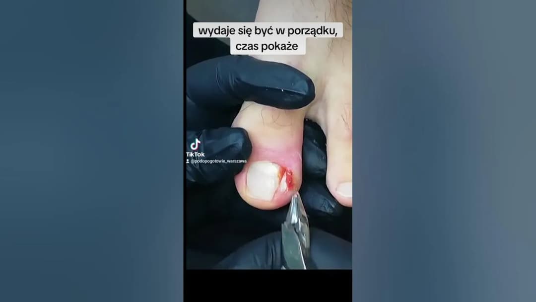 Jak wyciąć wrastający paznokieć i uniknąć bólu oraz komplikacji